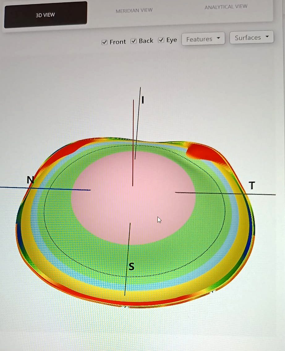 הדמיית העדשה המעוצבת על גבי העין בתצוגת 3D, עם אזור אופטי, פריפריה ואזור נחיתה
